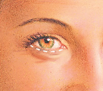blefaroplastia