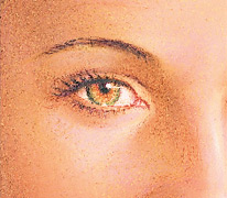 blefaroplastia_1
