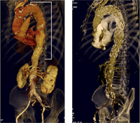 Aneurisma de aorta torácica