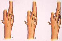 Esquema explicativo de la formación de embolia debido a lesiones en la arteria carótida