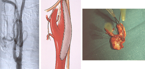 Tratamiento enfermedad carotida