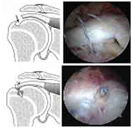 Reparación del manguito rotador con arpones y suturas