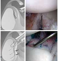 Reparación de ligamentos en luxación de hombro