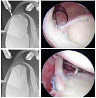 Reparación de ligamentos y bíceps