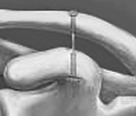 Reparación de ligamentos de la clavícula