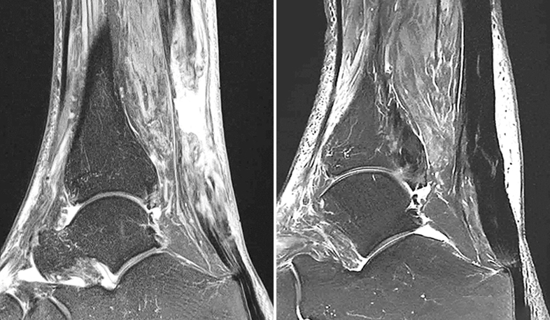 como-se-puede-curar-la-tendinopatia