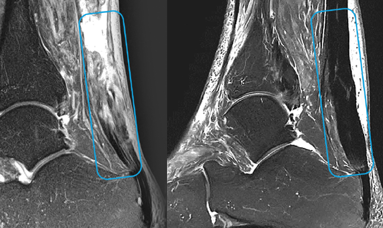 lesiones del tendon itrt