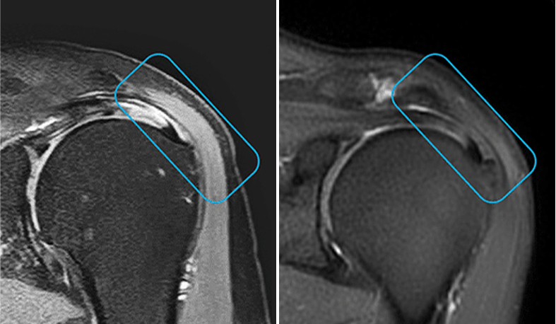 antes-y-despues-de-una-artrosis-con-terapia-celular-avanzada