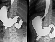 EGDT (Oesophageal-gastro-duodenal transit) | Centro Médico Teknon