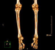 Lower leg arterial CT angiography | Centro Médico Teknon